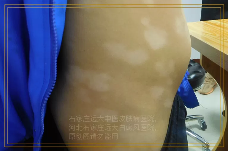 注意：女性频繁进出美容机构会诱发白斑发生!