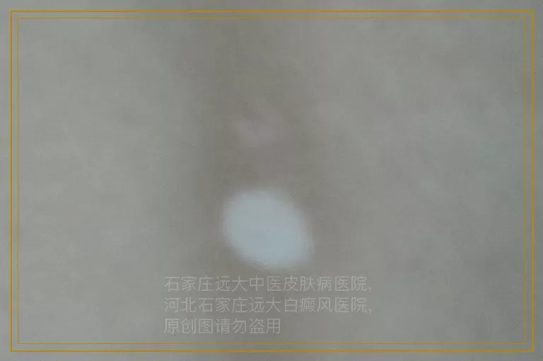 女性有白癜风还能不能化妆