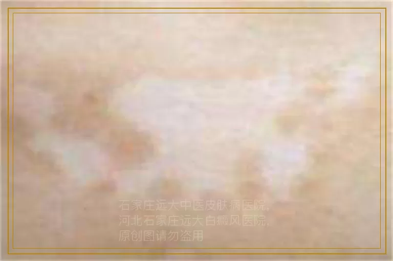 女性白癜风初期治疗要注意哪些