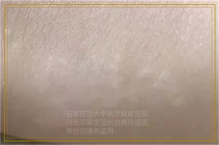 女性身上白癜风治疗方法有哪些