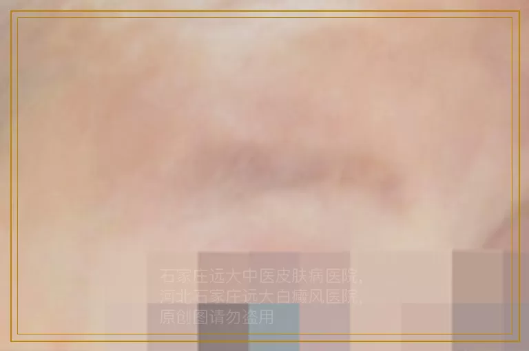 女性白癜风患者用什么治疗方法好