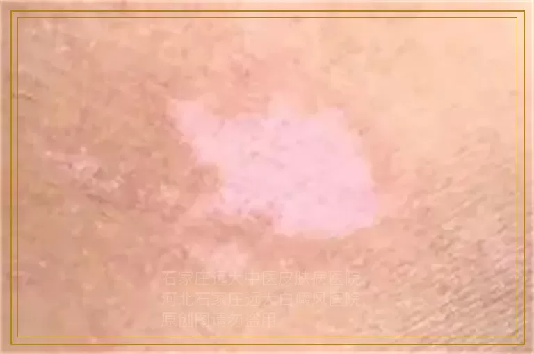 治好白癜风 再现女人美丽