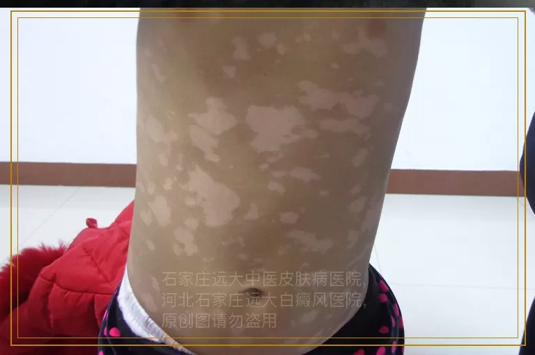 治疗女性白癜风要花多长时间