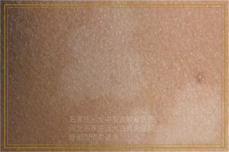 女孩私密处长白癜风的原因有哪些