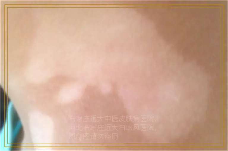 女性背部初期白癜风有哪些症状