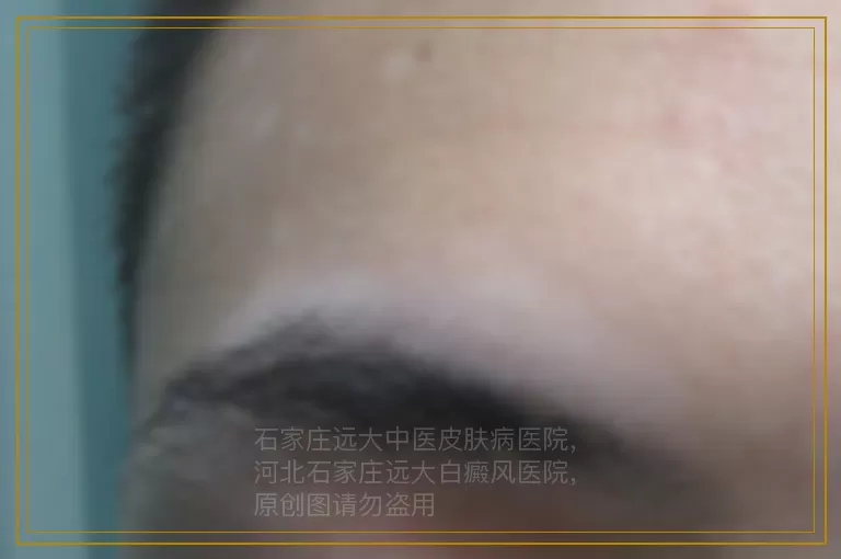 女性白癜风在治疗时要注意什么