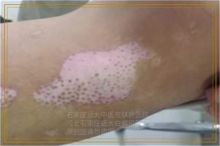 女性白癜风能怀孕生子吗