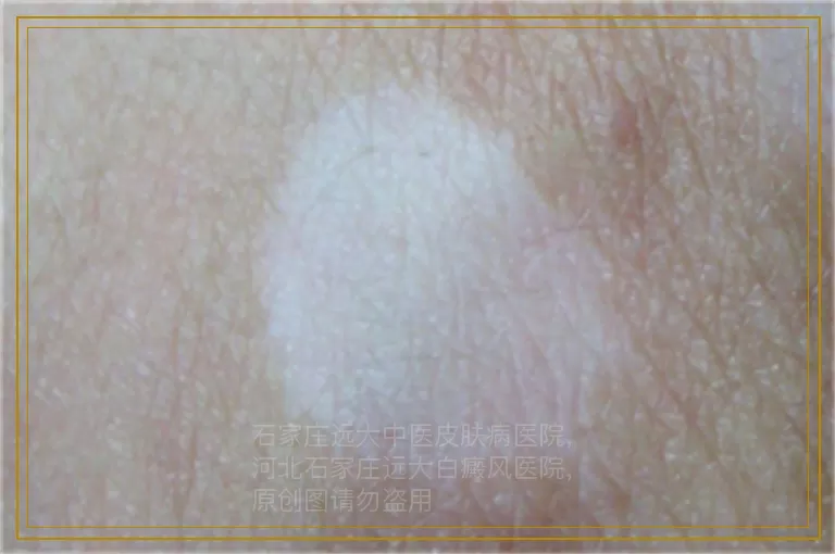 白癜风痊愈的要点总结