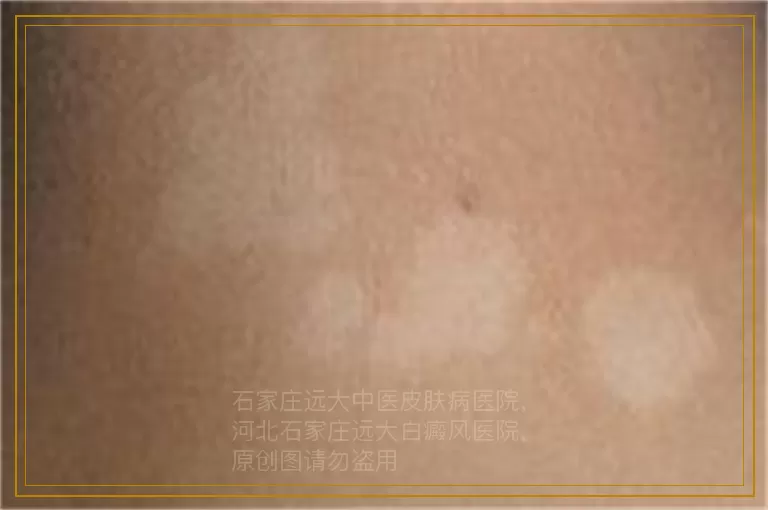 女性背部有大面积的白癜风该怎么治