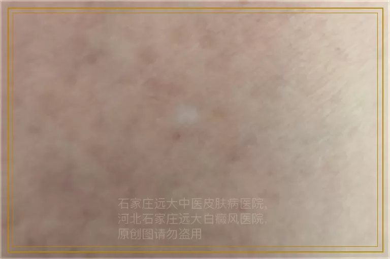 女人脸部白癜风激光过后黑色素长得快吗