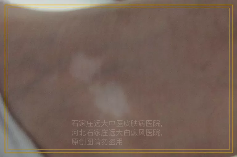 孕妇有白癜风要注意哪些