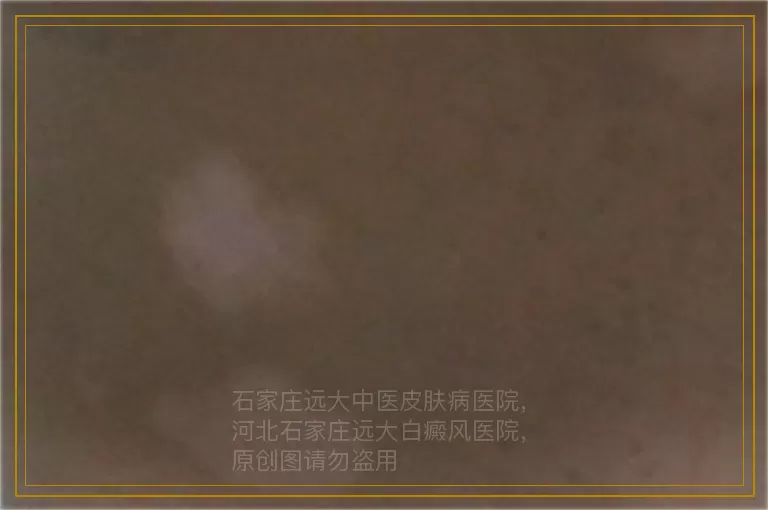 青年白癜风怀孕要怎么治