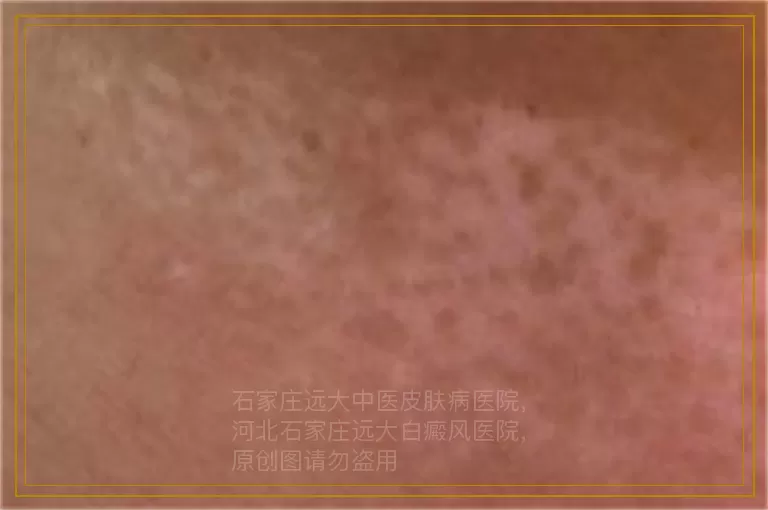 怀孕期间白癜风白斑容易扩散吗