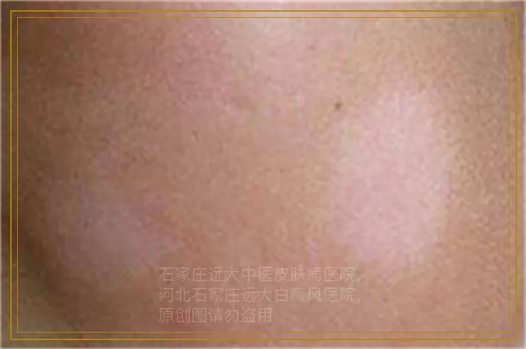 孕妇白癜风患者早期能吃药吗