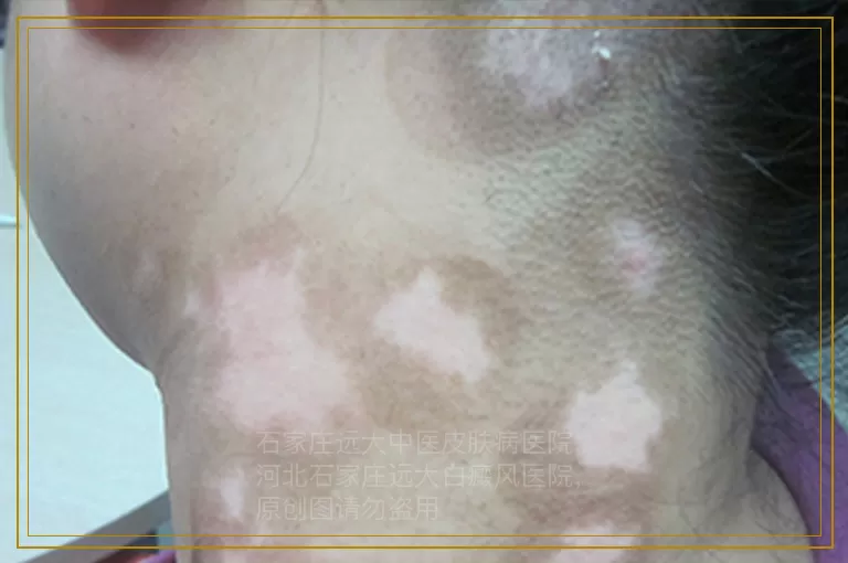 女白癜风的发病原因是什么呢?