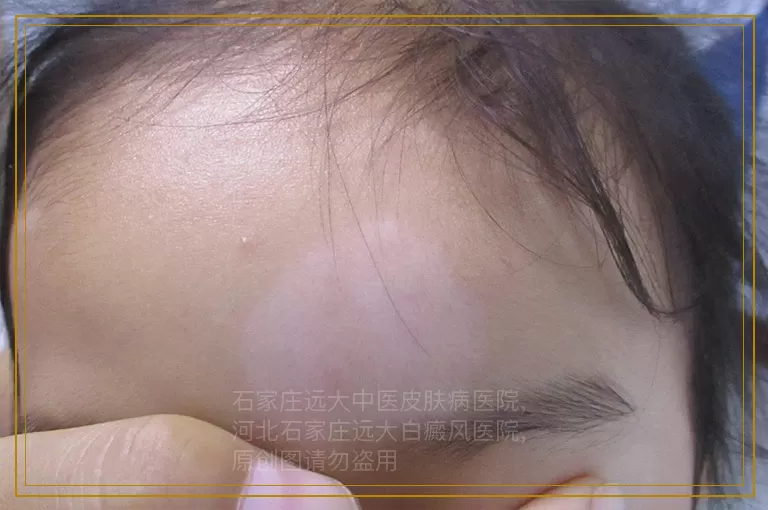 女性白癜风久治不愈，小心是化妆品作祟