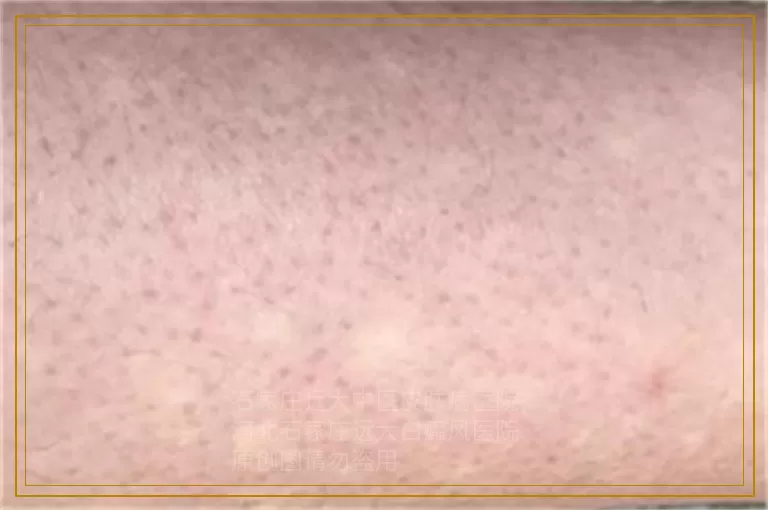 白癜风治疗的食疗方法