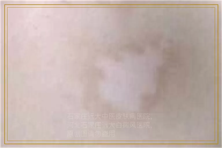 怀孕2个月长白癜风能照308激光吗