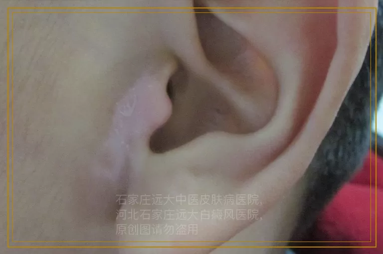 产后白癜风复发该怎么办