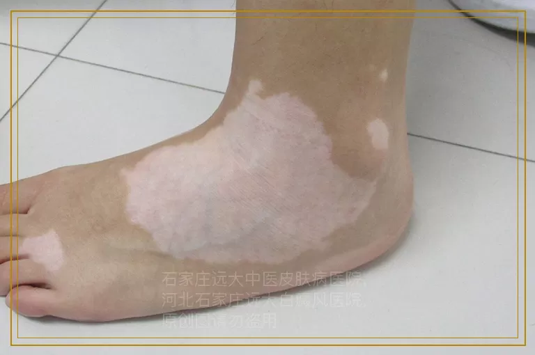 女性白癜风怎么治疗好转快