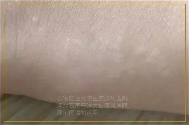 怎么治疗孕妇身上的白癜风