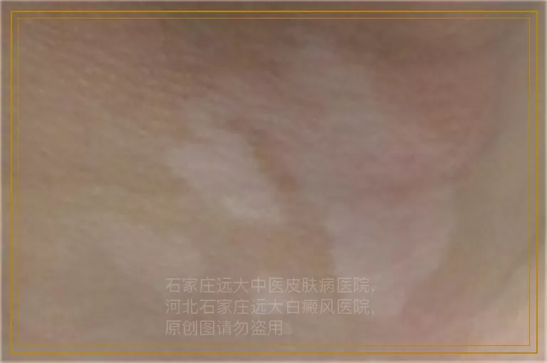 女性爱美需适度 当心白斑上身