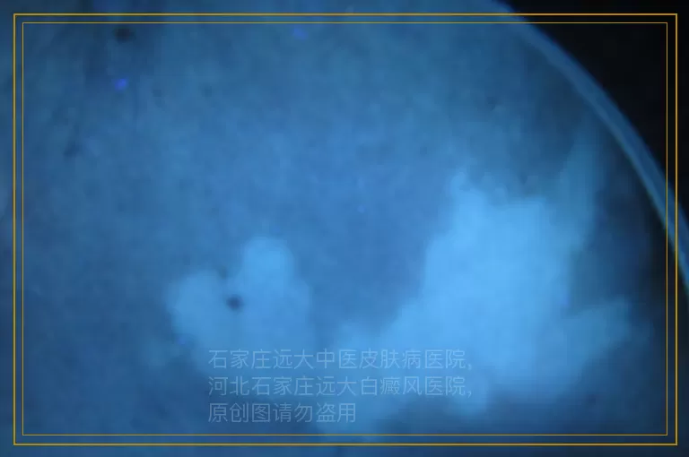 女性白癜风使用化妆品需要注意的问题