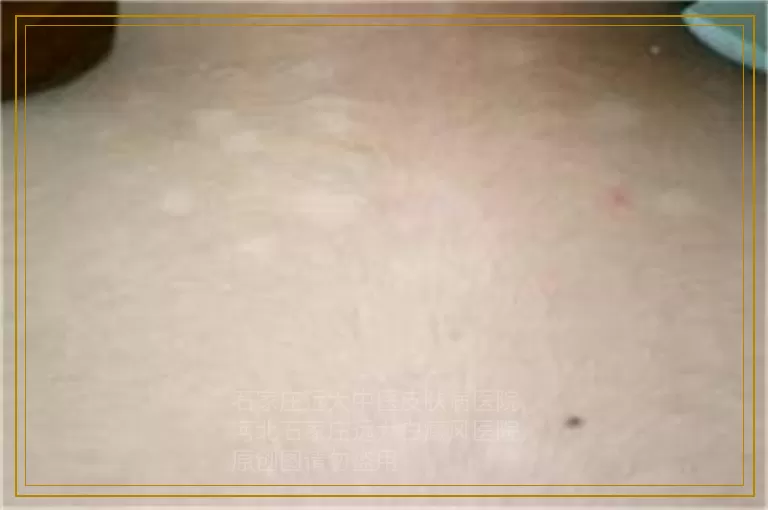 白癜风患者怀孕了要怎么继续治疗