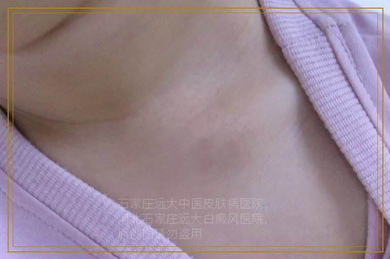 女孩子面部长白癜风能治的好吗