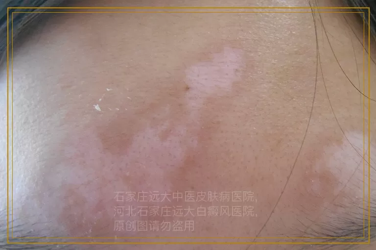 白癜风要针对性治疗