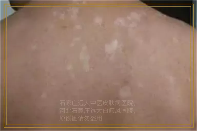 女性脸部长白癜风的原因是什么
