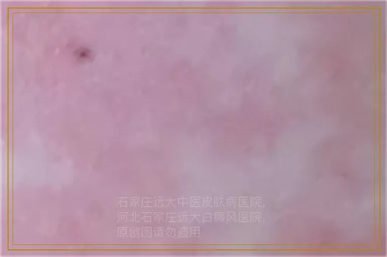 怎样治疗女性白癜风病