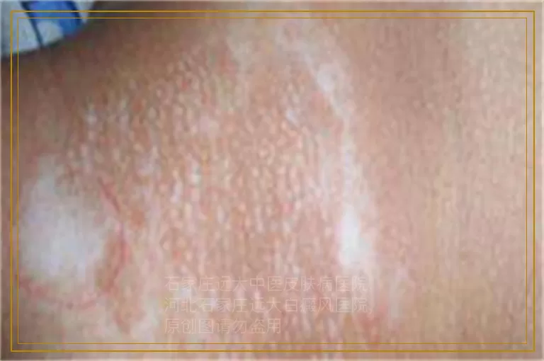 女士白癜风久治不愈都是因为这些