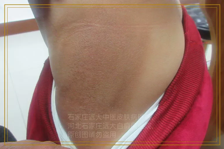 备孕期间白癜风复发了怎么办