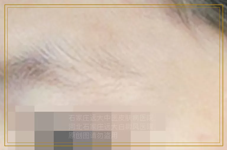 女性手指白癜风早期症状