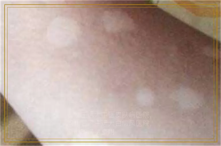 孕妇发展期白癜风适合做308激光吗