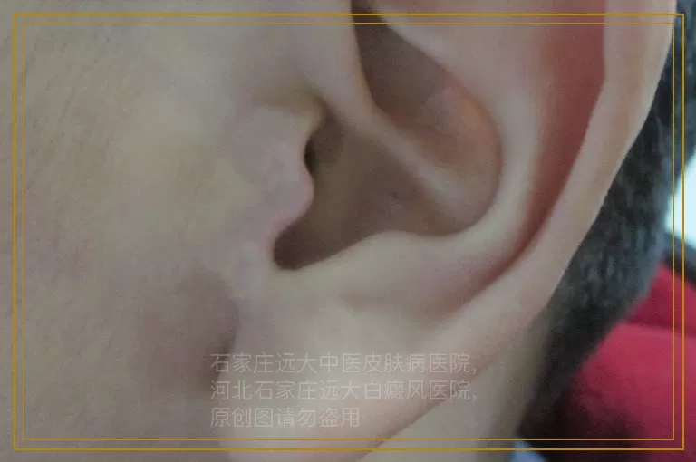 影响女性患白癜风的因素有哪些