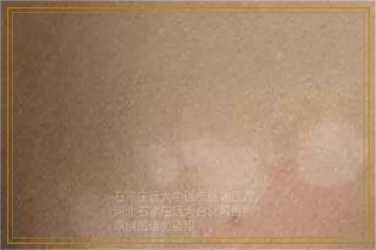 白癜风女性对生育影响大不大