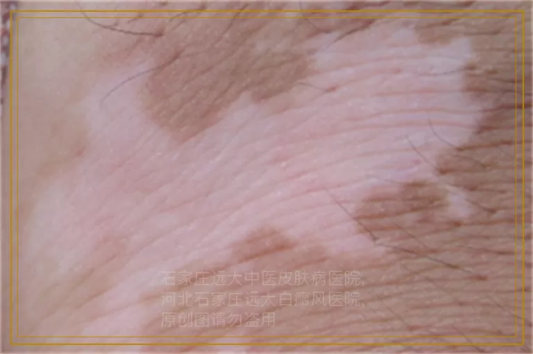 女性皮肤上有小白点是不是白癜风症状?