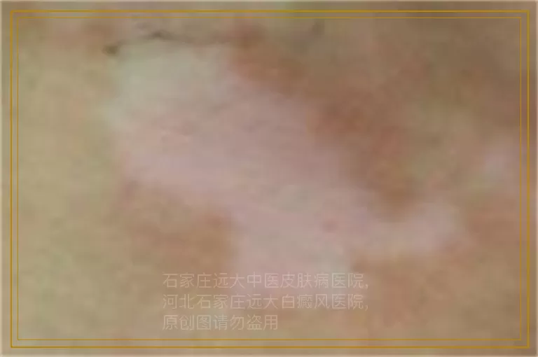 女性皮肤白点图片 [中医]治疗白点的方法
