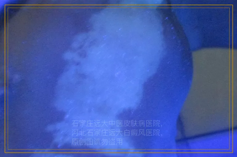 女性白癜风发病是哪些原因造成的