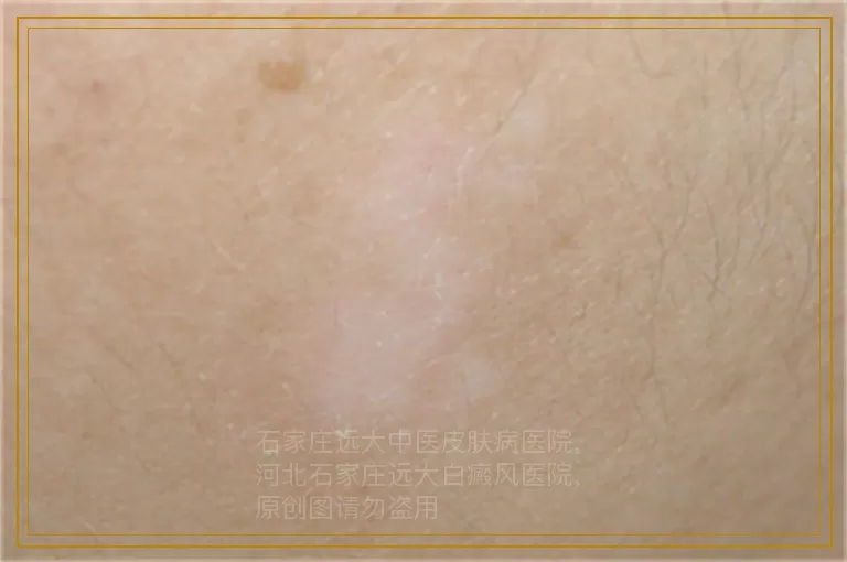 治疗白癜风贵在坚持