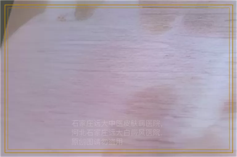 女性白癜风患者怀孕期间还能做308光疗吗