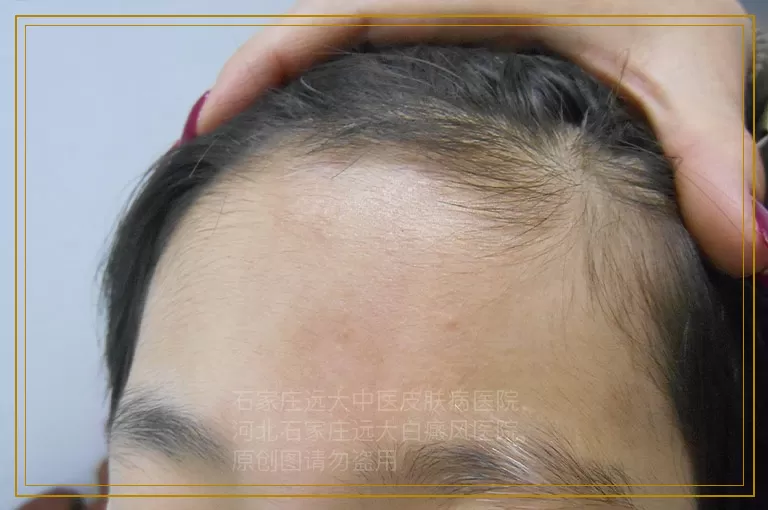 孕妇白癜风扩散该怎样控制住