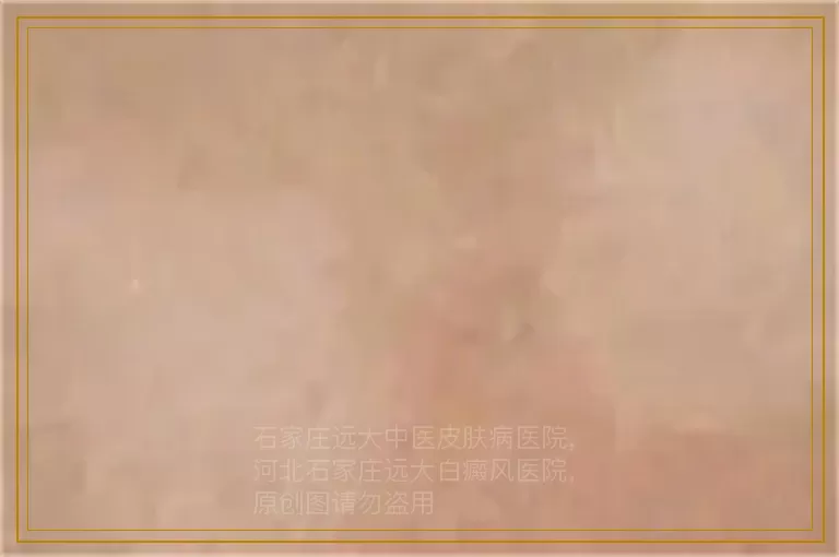 女性面部出现白斑是哪些原因造成的