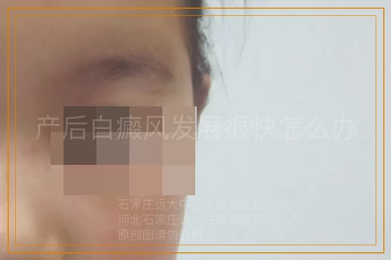 产后白癜风发展很快怎么办