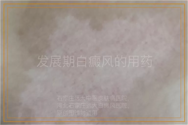 发展期白癜风的用药