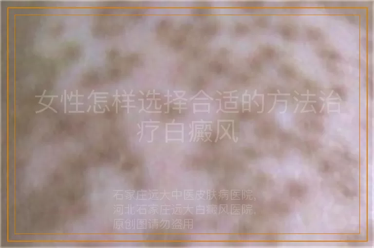 女性怎样选择合适的方法治疗白癜风