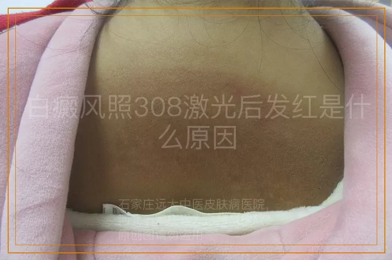 白癜风照308激光后发红是什么原因