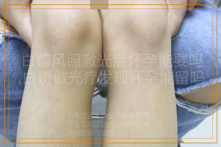 白癜风照激光后怀孕能要吗,白斑做光疗发现怀孕能留吗,白癜风患者怀孕前照光影响胎儿吗